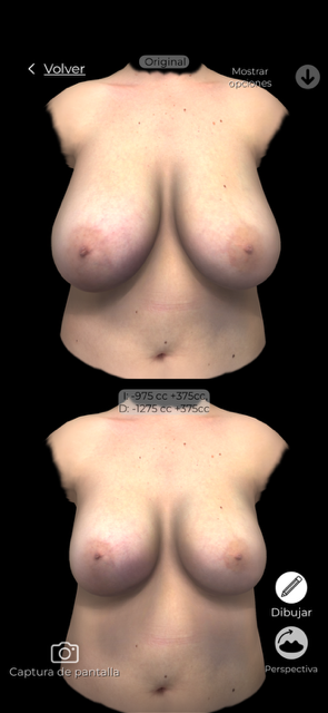 Simulación 3D de aumento de pecho — Aumento con elevación · Caso real · Instituto Rubí.